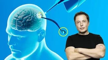 Anuncia Elon Musk exitoso implante de un chip cerebral en humanos
